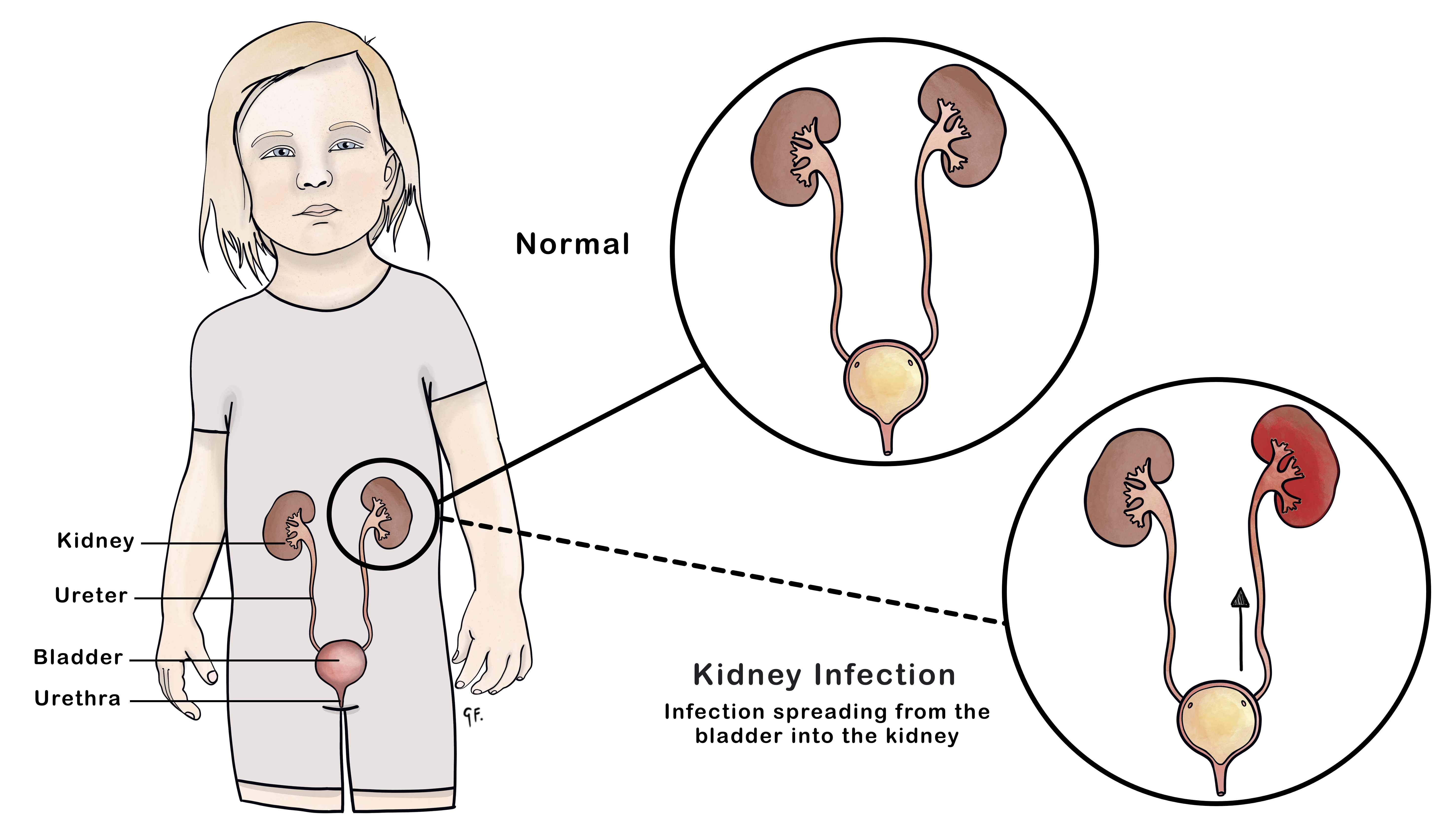 kidney-infections-in-children-kidshealth-nz